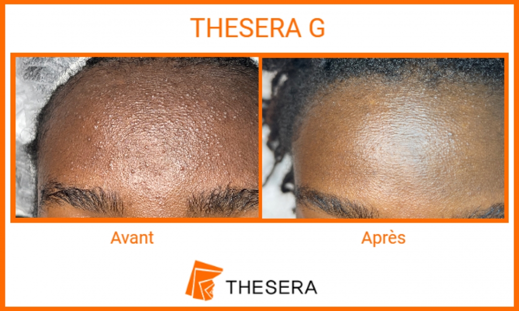 soin peeling thesera G avant-après