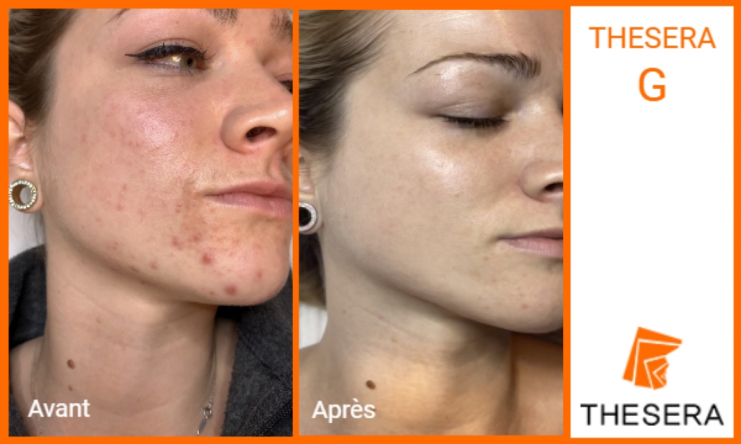 soin peeling thesera G avant-après