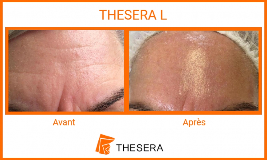 thesera L avant-après front