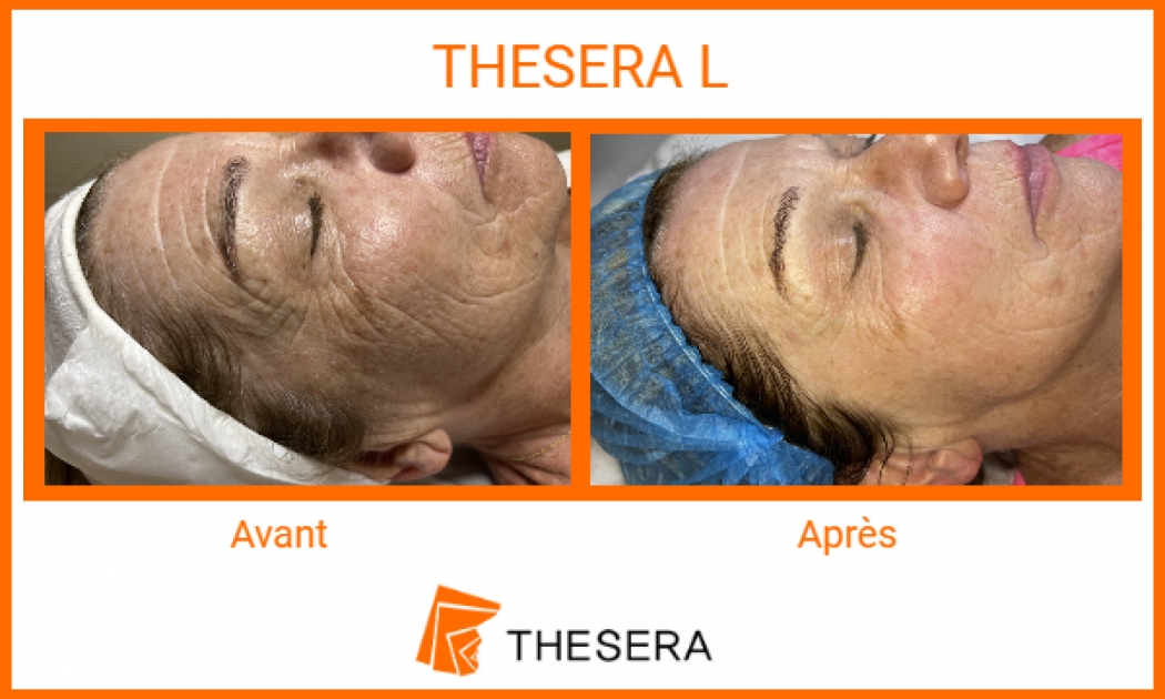 thesera L avant-après visage